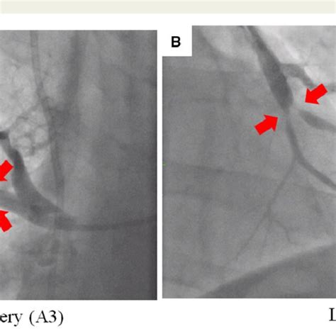 Pulmonary angiography. Pulmonary angiography shows multiple webs and ...