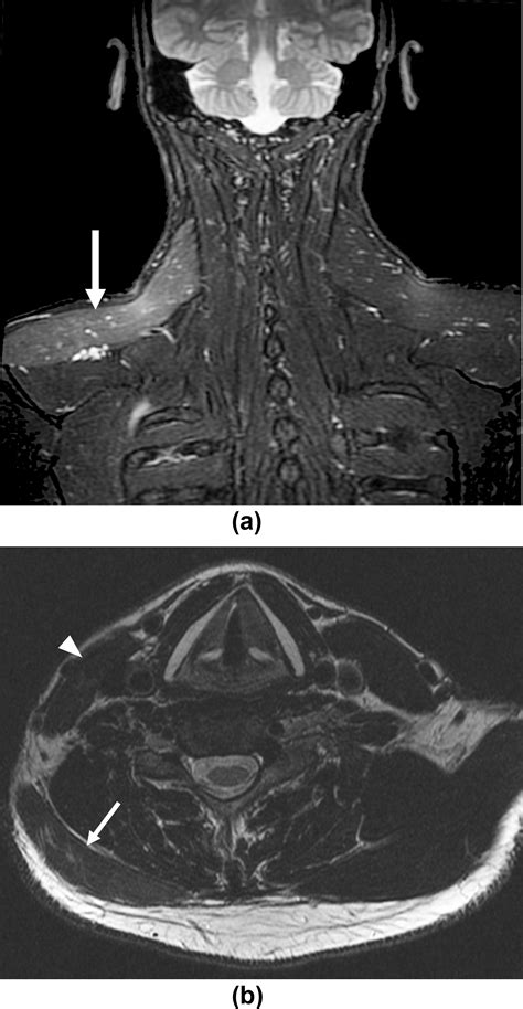 Mri Findings Of Spinal Accessory Neuropathy Clinical Radiology