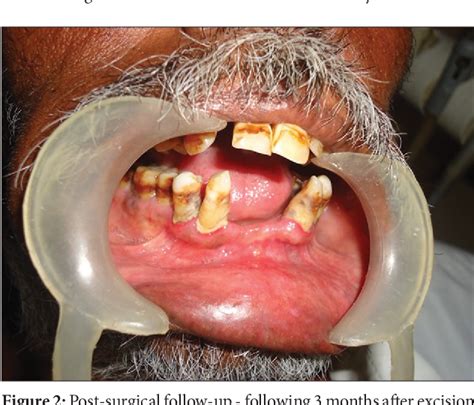 Figure 2 From Recurrent Epulis Granulomatosa A Second Look Semantic