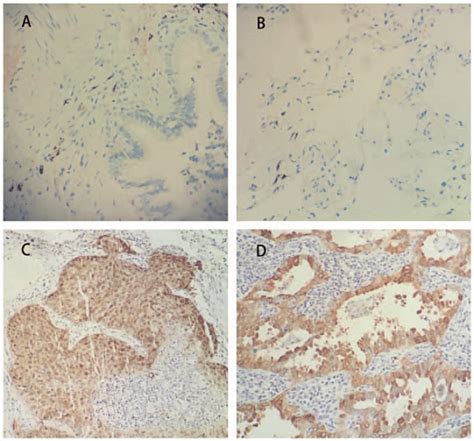 Cep Expression In Nsclc Tissue Samples Negative Or Weak Cep