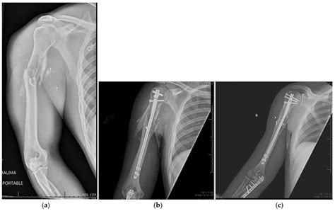 Jcm Free Full Text Management Of Proximal Humerus Fractures In