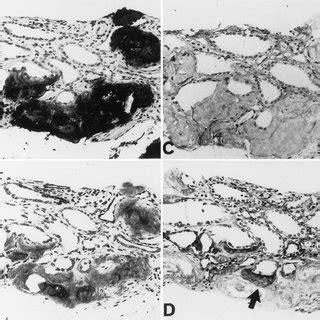 Immunohistochemical Localization Of Aa Amyloid Protein A Cml B