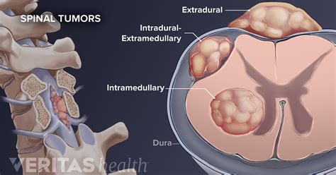 Intradural-Extramedullary Tumor Definition | Back Pain and Neck Pain ...