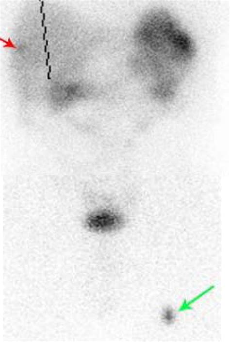 Skeletal Muscle Metastases In A Patient With Neuroendocrine Tumor