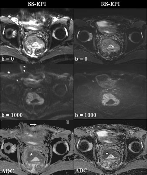 Figure 2 From Readout Segmented Echo Planar Imaging For Diffusion