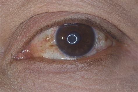 Pterygium Removal West Palm Beach Pinguecula Florida