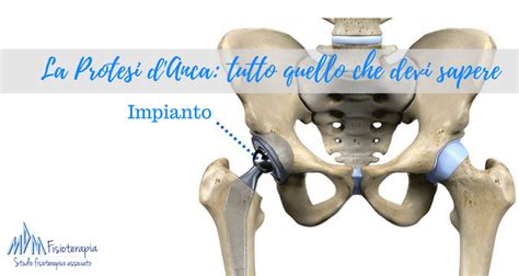 Protesi Anca Una Guida Passo Passo Mdm Fisioterapia