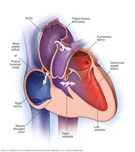 Tricuspid atresia - Symptoms and causes - Mayo Clinic