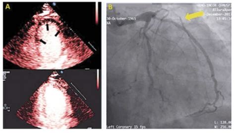 Ecocardiografia Contraste De Microbolhas