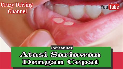 Cara Mengobati Sariawan Di Bibir Dengan Cepat Dan Menggunakan Obat