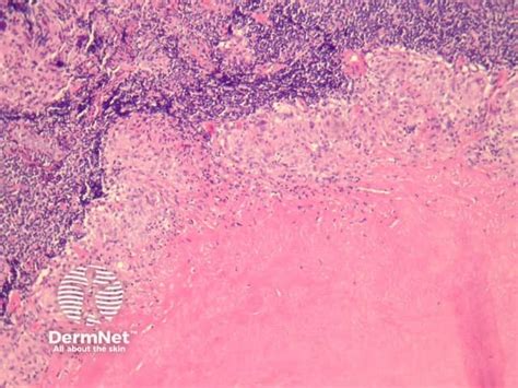 Cutaneous Tuberculosis Pathology