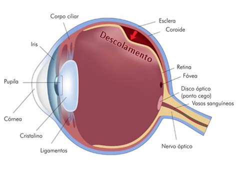 tratamento para descolamento de retina em crianças em curitiba Dr