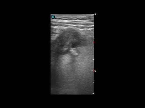 Дивертикулит сигмовидной кишки. Sigma's diverticulitis - YouTube