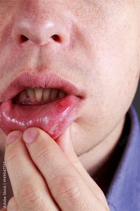 Stomatitis Types Causes And Treatment 41 Off