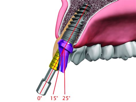 Alpha Implant H Rek Dental Hu