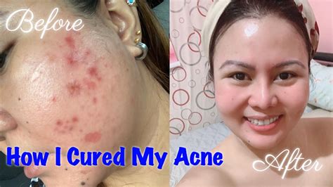 How I Cured My Acne What To Do Pimple Treatment My Acne Journey