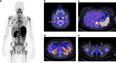 Whole Body Scan Shows Complexity Of Immunotherapy Response • Healthcare