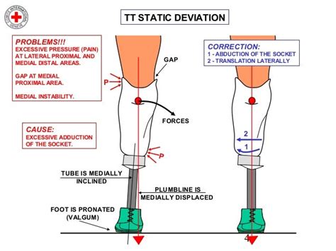 Transtibial Static Alignment