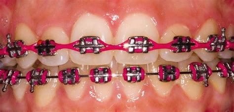 Burgundy Braces Bands Power Chain On Top Get The Latest In Orthodontic