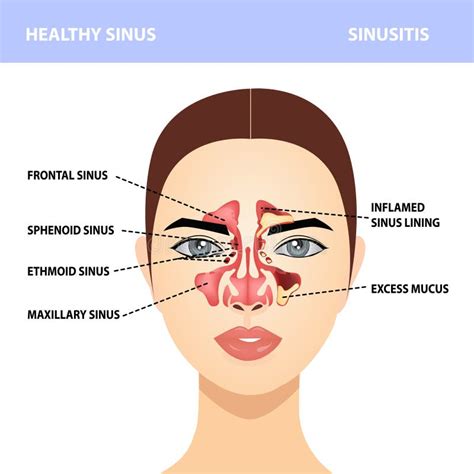 Sinusitis Healthy And Sinus Infections Signs Realistic Illustration