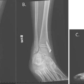 Post Operative Radiographs Figure 4 A AP B Mortise And C