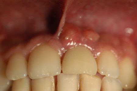 Fístula dental características causas e alternativas de tratamento