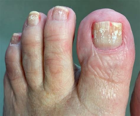 Why Are My Toenails Yellow Causes And Treatment Atelier Yuwa Ciao Jp