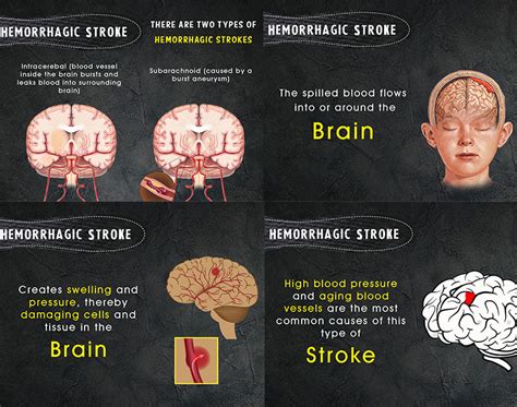 Types Of Strokes Kauvery Hospital