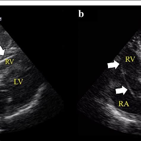 Subcostal 4-chamber view (a) and apical 4-chamber view (b)... | Download Scientific Diagram