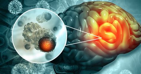 Cuáles son los síntomas de un cáncer terminal