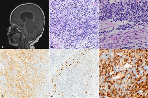 A Case Of Etmr Like Dicer Associated Embryonal Tumor A Sagittal T