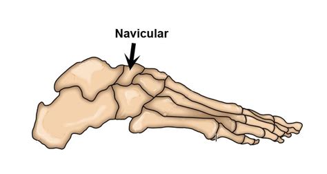 Navicular Stress Fracture - Symptoms, Causes, Treatment & Rehabilitation