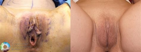 Labiaplasty Before And After Pictures Case Denver And Colorado