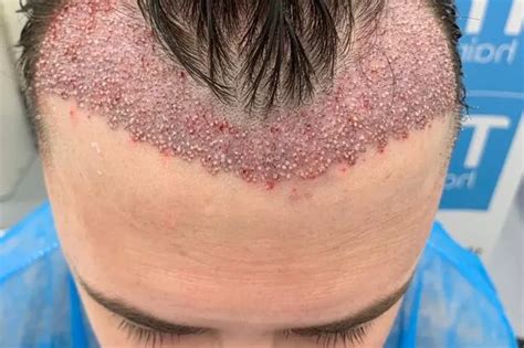 The Reality Of Hair Transplants From Side Effects To Whether Results Last Daily Star