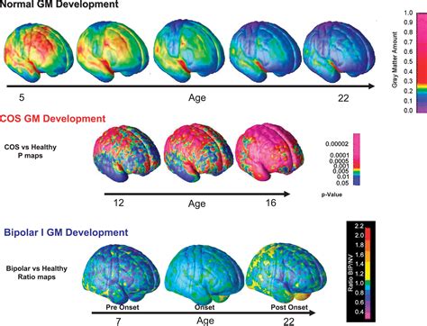 Schizophrenic Brain Compared To Normal Brain