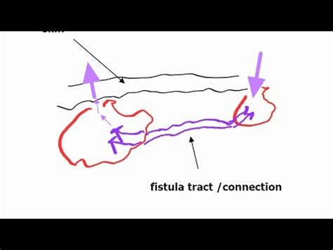 재발하는 피부염증 cutaneous fistula YouTube