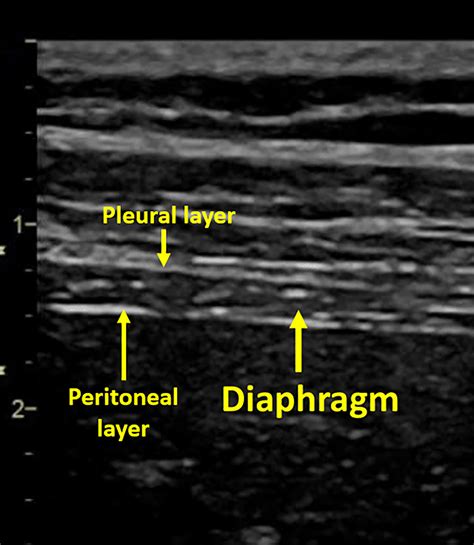 Imaging Of The Diaphragm Following Cardiac Surgery Focus On