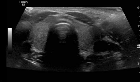 Thyroid Ultrasound Protocol Sonographic Tendencies