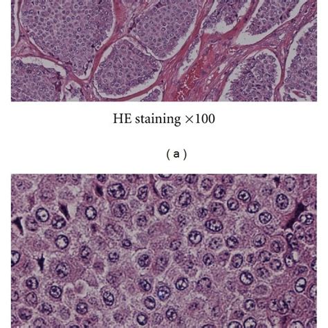 Histologic Study Of Resected Tumor By Hematoxylin And Eosin Stain