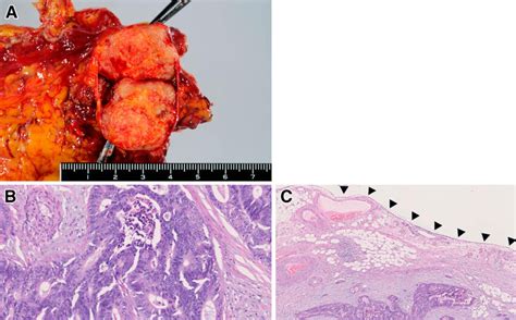 A: The resected tumor with the greater omentum was a solid white mass,... | Download Scientific ...