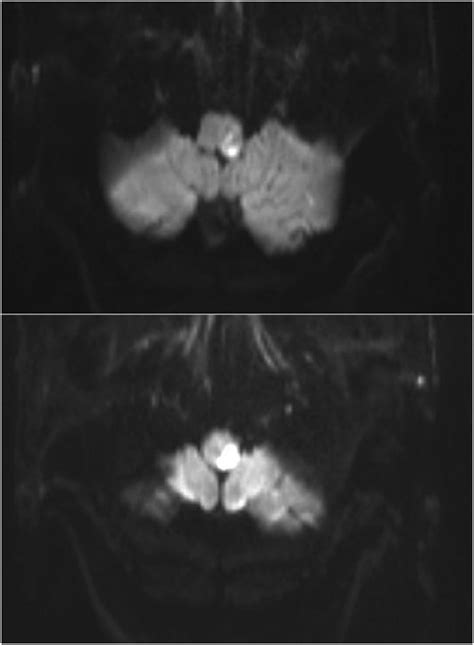 Mri Dwi Showed A High Signal Intensity Area On The Lateral Side Of The