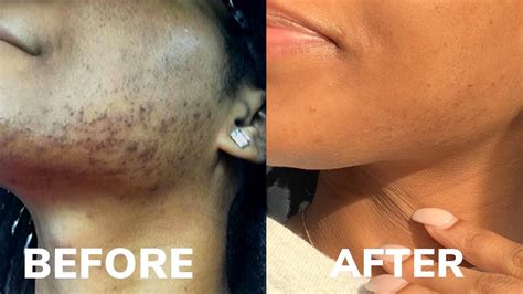 Is Chin Laser Hair Removal Worth It | Lipstutorial.org