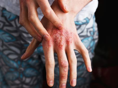 Psoriasi Prevenire Infezioni E Micosi Derma Point