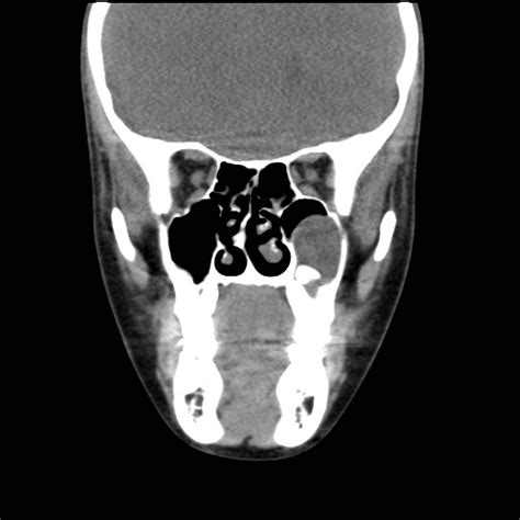 Dentigerous Cyst Image