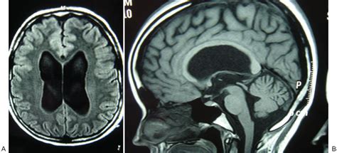 Hydrocephalus Mri Brain