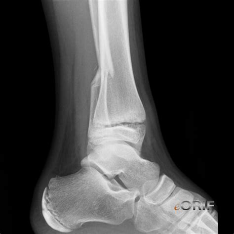 Icd 10 Code For Left Distal Fibula With Tibia Fracture