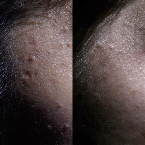 Hypertrophic Scars Treatment Before And After Scar Healing Institute