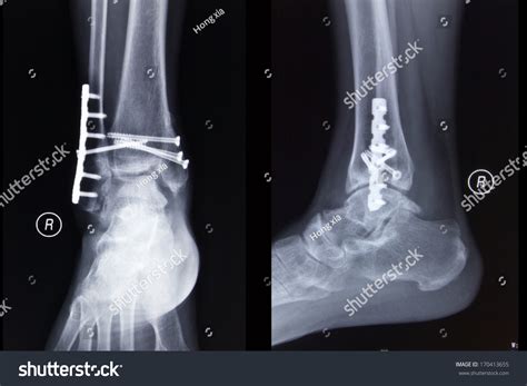 Right Ankle Fracture After Operation Stock Photo 170413655 Shutterstock