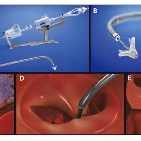 Key Valve Eligibility Criteria For Mitraclip ® Download Scientific Diagram