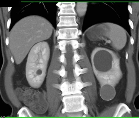 Bosniak 2F Cyst Lower Pole Left Kidney - Kidney Case Studies - CTisus CT Scanning